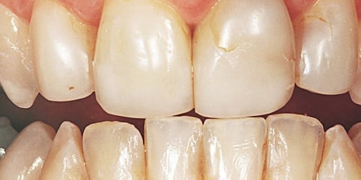 Wisdom Teeth Extractions: What You Need to Know Before Going Under the Forceps