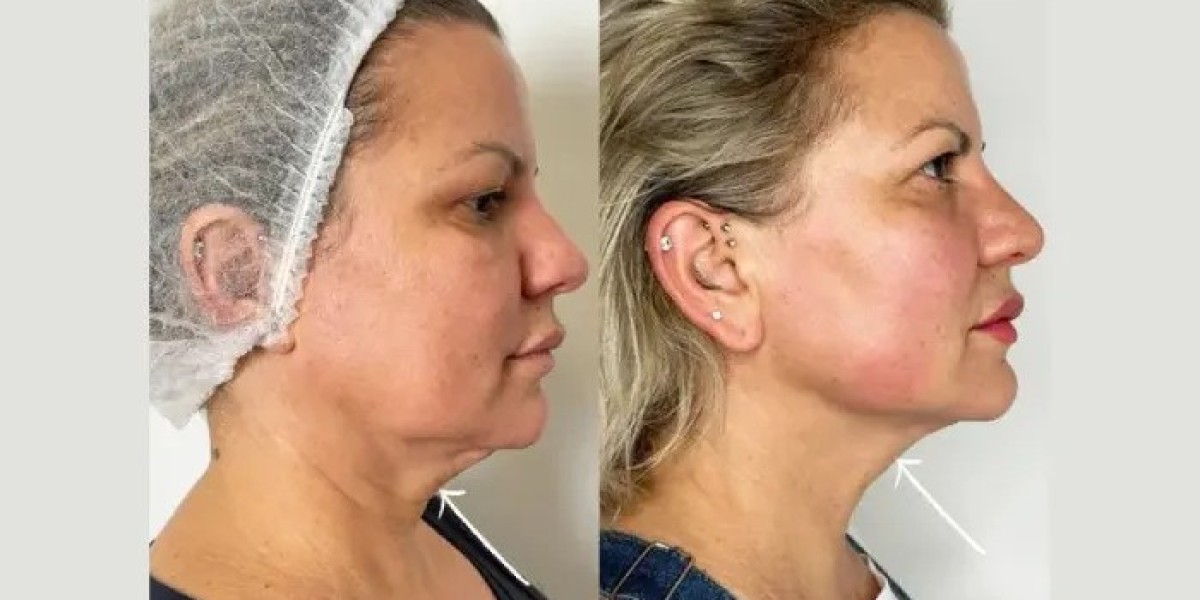 Best Doctors in dubai for Premium Endolift Skin Tightening Solutions