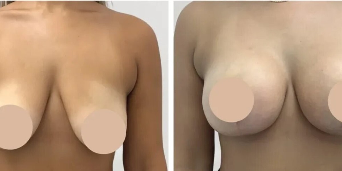 Breast Reduction in Dubai: Achieving Natural-Looking Contours