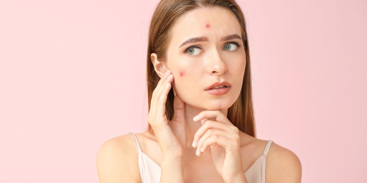 Acne Treatment in Dubai: Best Ways to Prevent Future Breakouts