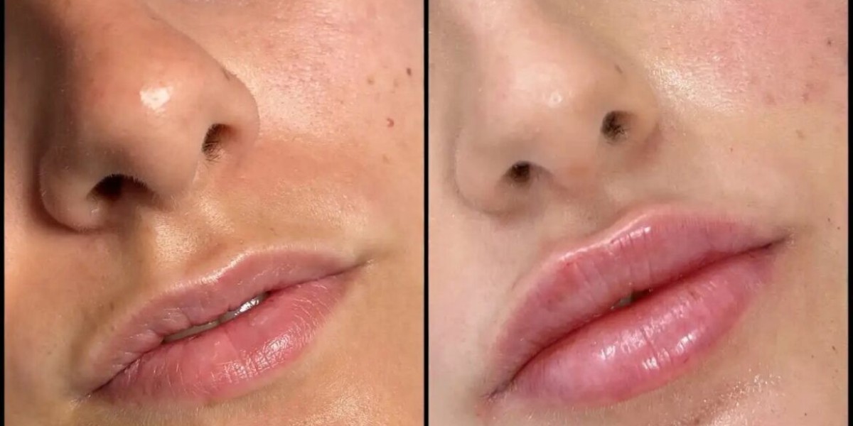 Fillers in Dubai for Smooth and Balanced Results