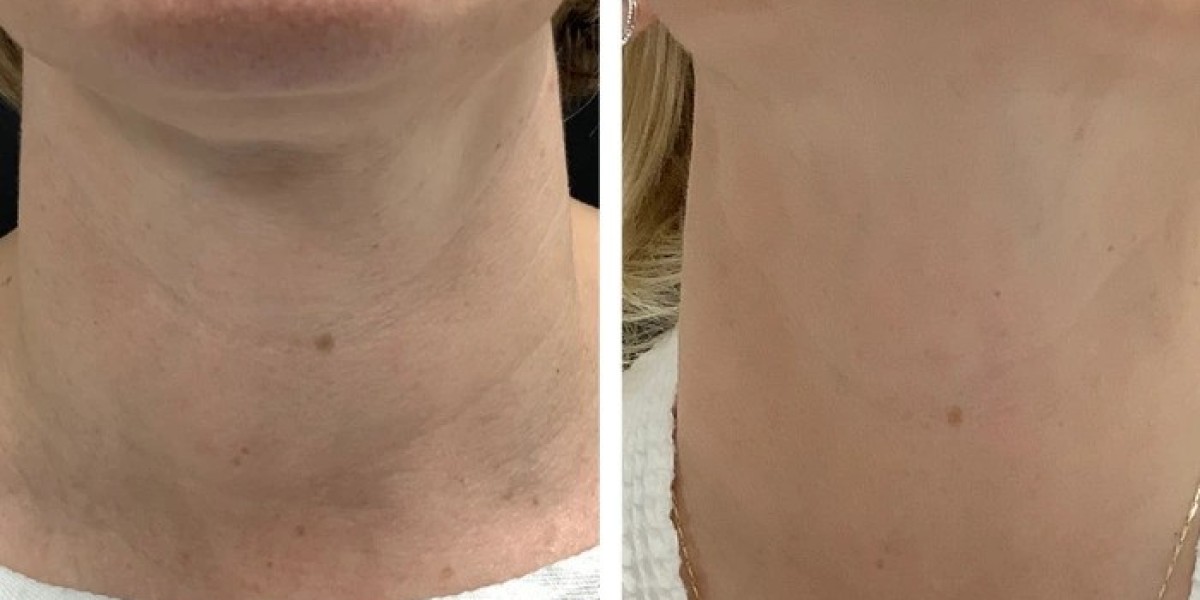Best Doctors in dubai for Innovative Radiofrequency Microneedling Skin Rejuvenation