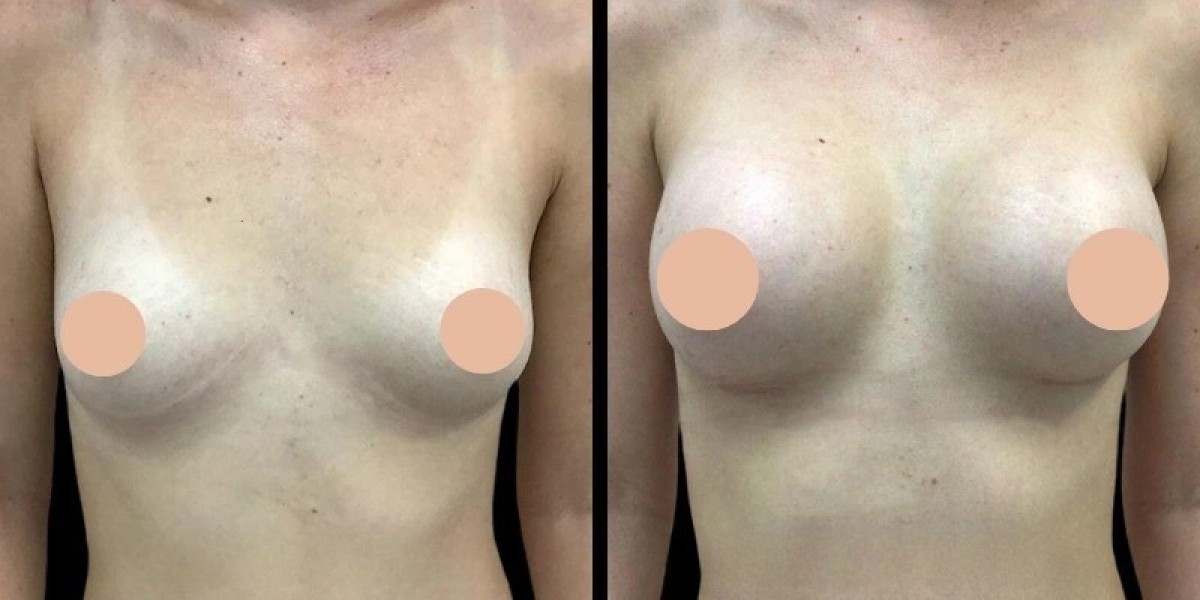 Best Doctors in Dubai for Common Breast Augmentation Questions
