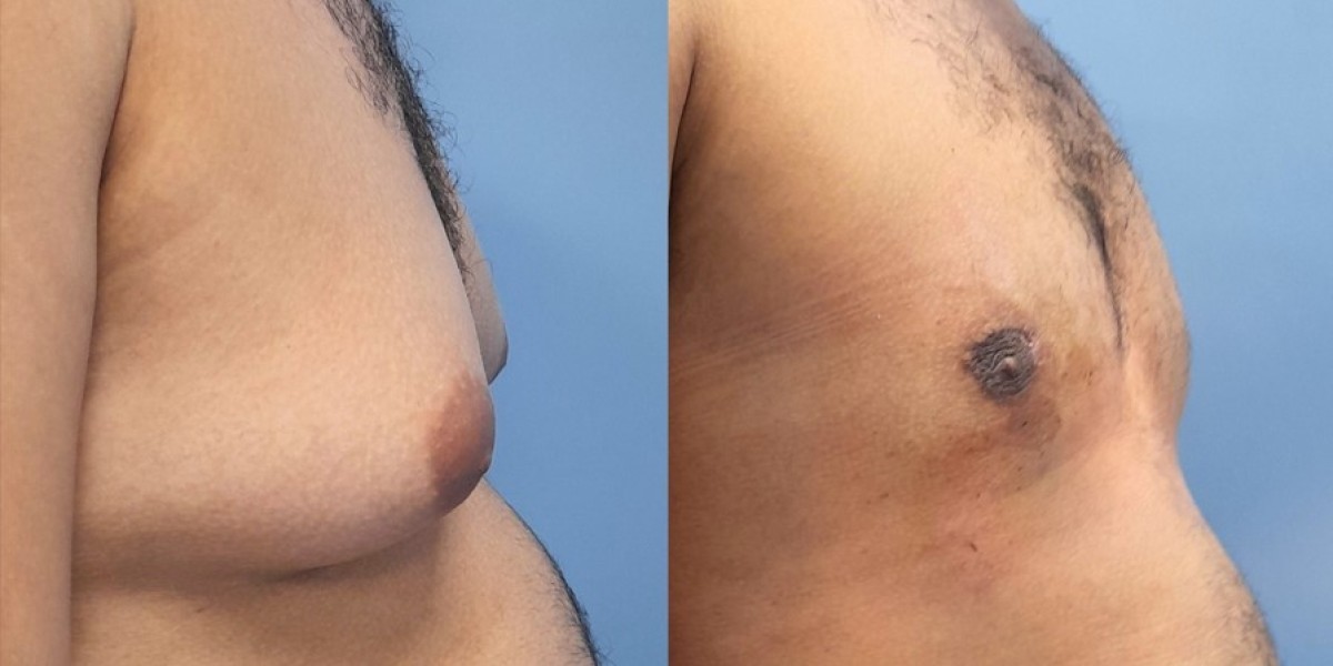 Liposuction in Islamabad: Procedure, Benefits, and Recovery