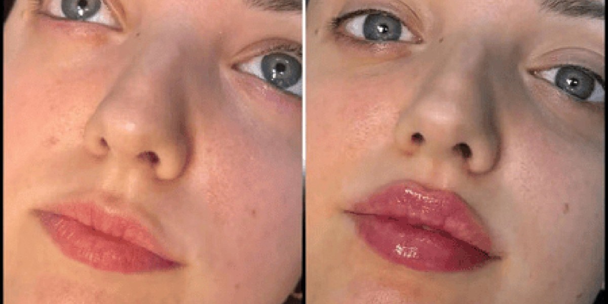 Best Doctors in Dubai: Using Premium Dermal Fillers