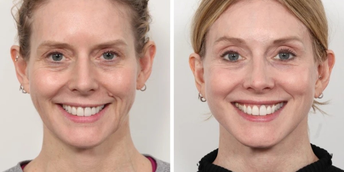 Best Aesthetic Clinic in Dubai for PDO Thread Lift and Facial Contouring