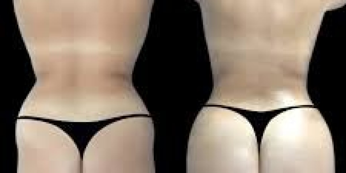 Recovery Milestones After Butt Fat Transfer With the Best Butt fat transfer Surgeon in dubai