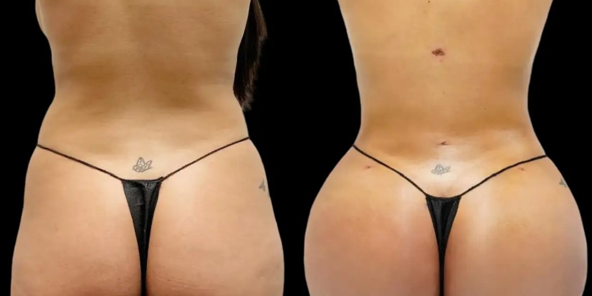 How the Best fat transfer Surgeon in dubai Uses Modern Surgical Techniques