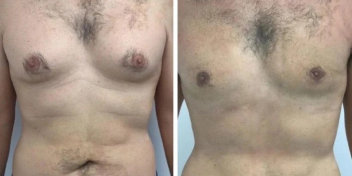 Gynecomastia Surgery in Dubai:How Treatment Addresses Excess Chest Tissue